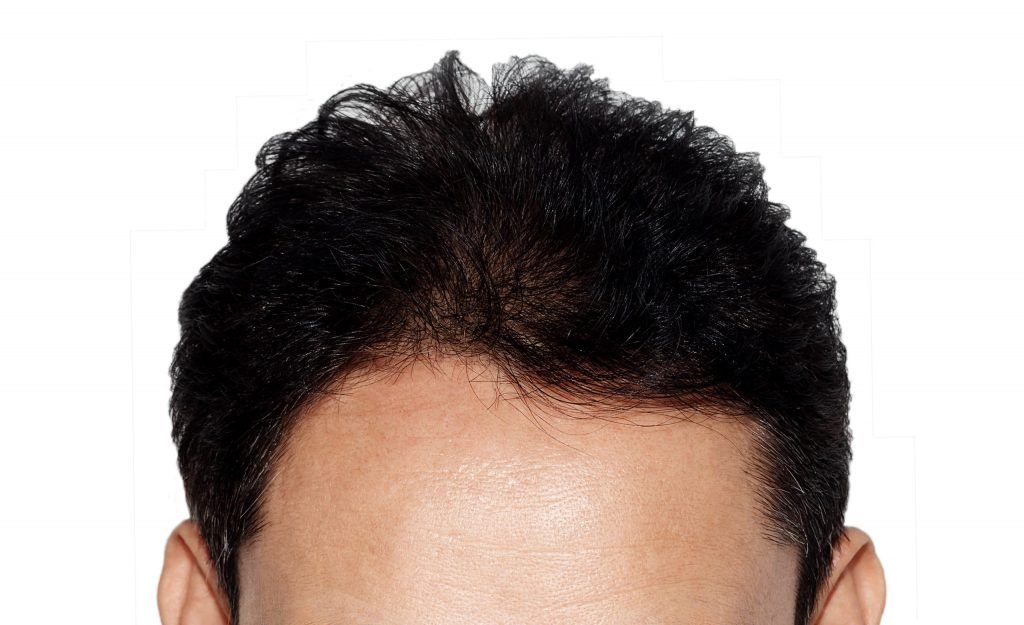 Hair Restoration London and Surrey Aesthetics 1