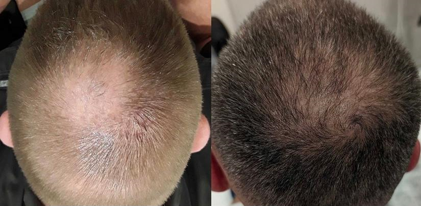 Microneedling 3 treatments