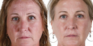 Filler for marionette lines - At London Surrey Aesthetics