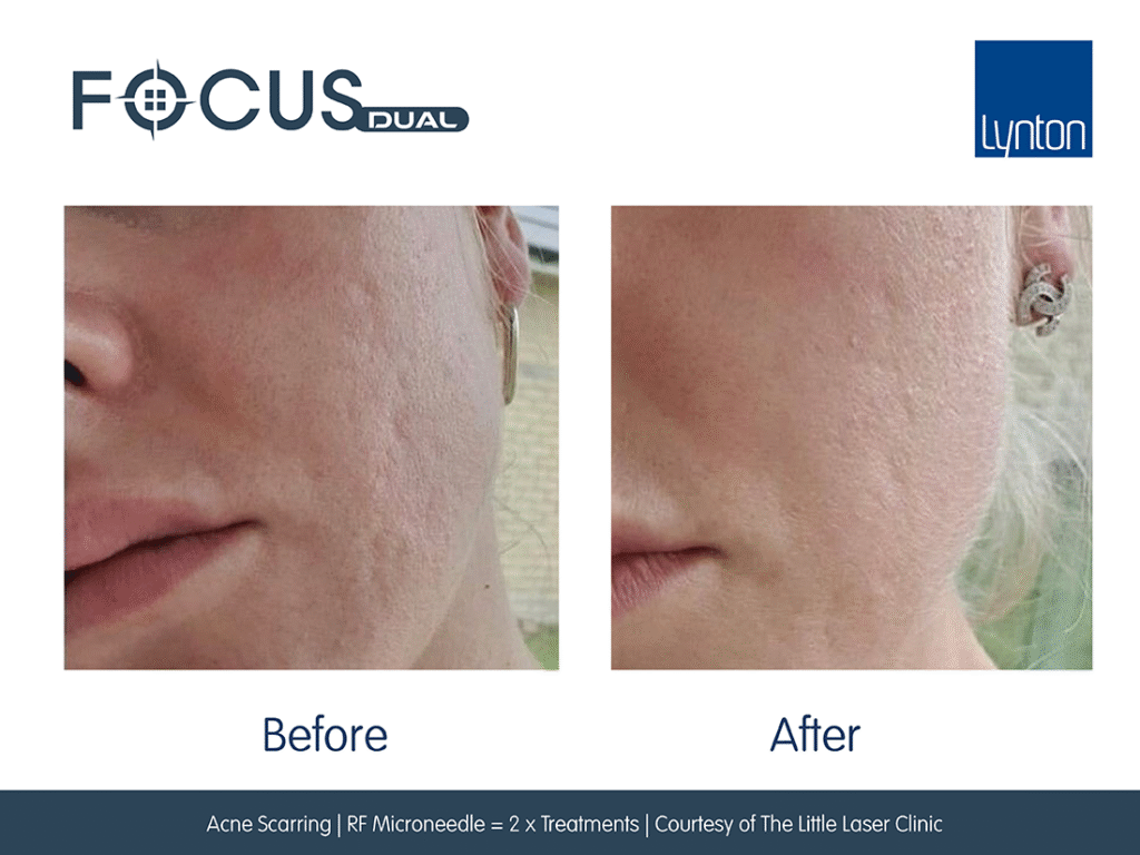 RF Microneedling or Radiofrequency Microneedling | Skin Rejuvenation London