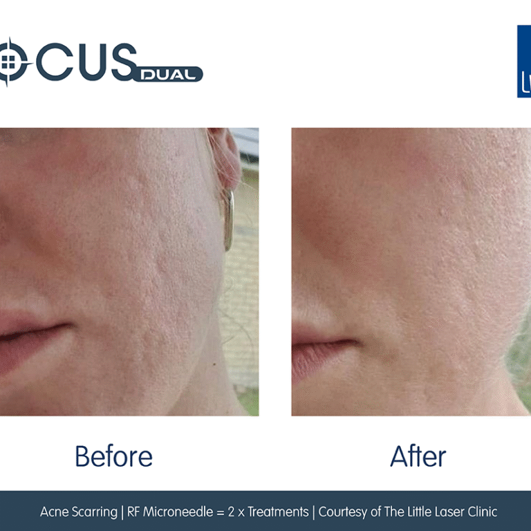 RF Microneedling or Radiofrequency Microneedling | Skin Rejuvenation London