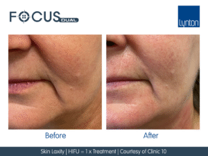 RF Microneedling HIFU Facial Treatment | Non-Surgical Skin Tightening Treatment London