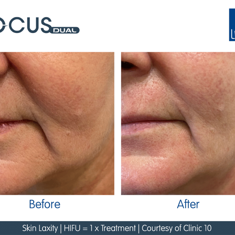 RF Microneedling HIFU Facial Treatment | Non-Surgical Skin Tightening Treatment London
