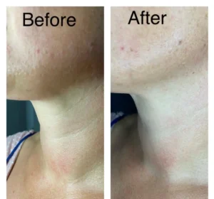 Regenerative Aesthetic Treatments - RF Microneedling London